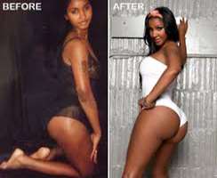 Bernice Burgos after surgery